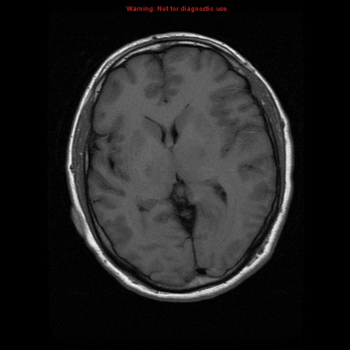File:Atypical meningioma - grade II (Radiopaedia 13303-13305 Axial T1 11).jpg