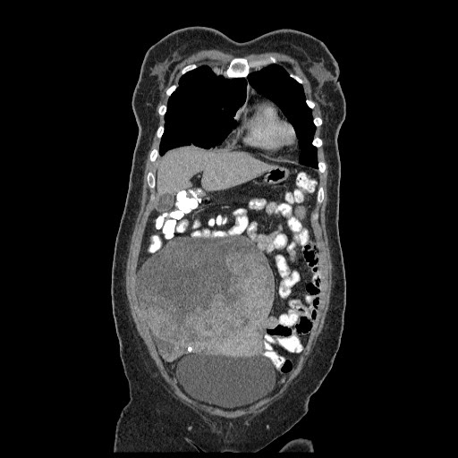 File:Atypical retroperitoneal lymphocoeles with large leiomyoma of uterus (Radiopaedia 32084-33024 B 4).jpg