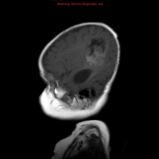 File:Atypical teratoid rhabdoid tumor (Radiopaedia 10712-11183 Sagittal T1 17).jpg