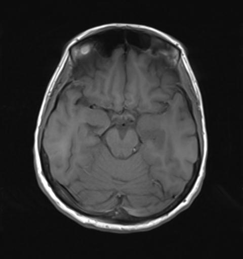 File:Autoimmune limbic encephalitis (Radiopaedia 30363-31005 Axial T1 13).jpg