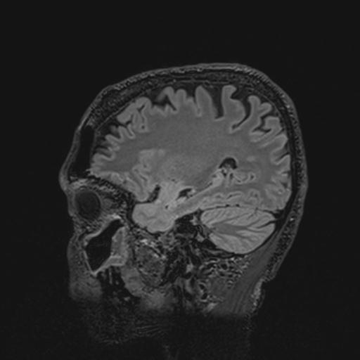 Autoimmune limbic encephalitis (Radiopaedia 30363-31005 Sagittal FLAIR 54).jpg