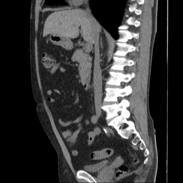 File:Autosomal dominant polycystic kidney disease (Radiopaedia 36539-38101 D 39).jpg