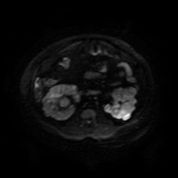 Autosomal dominant polycystic kidney disease (Radiopaedia 50259-55611 Axial DWI 60).jpg