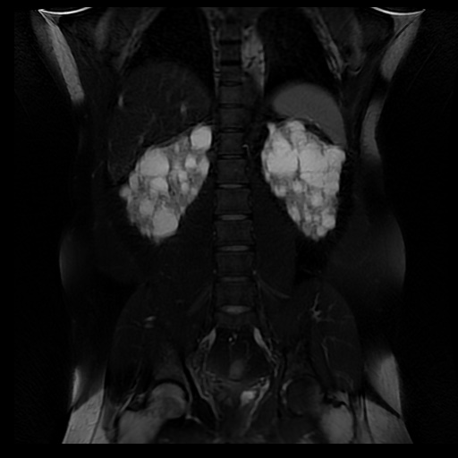File:Autosomal dominant polycystic kidney disease (Radiopaedia 50259-55611 Coronal T2 fat sat 25).jpg