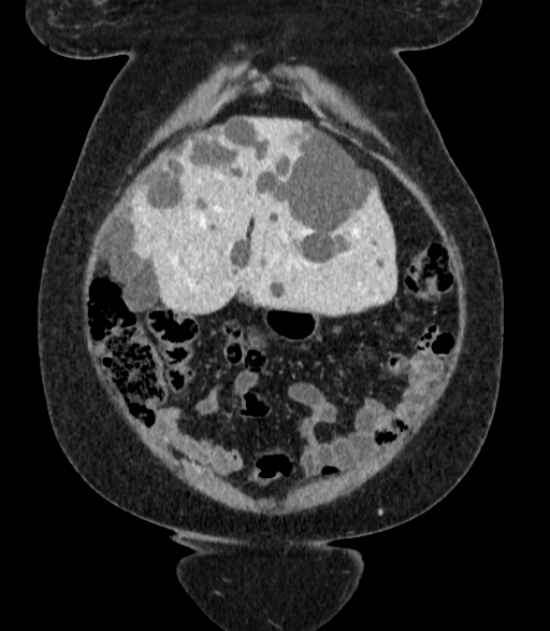 Autosomal dominant polycystic kidney disease (Radiopaedia 57124-64017 B 13).jpg