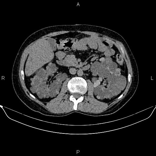 File:Autosomal dominant polycystic kidney disease (Radiopaedia 87830-104287 Axial non-contrast 24).jpg