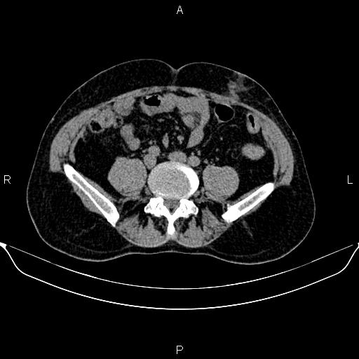 Autosomal dominant polycystic kidney disease (Radiopaedia 87830-104287 Axial non-contrast 37).jpg