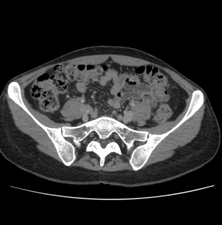 Autosomal dominant polycystic kidney disease - early onset (Radiopaedia 40734-43387 A 62).jpg