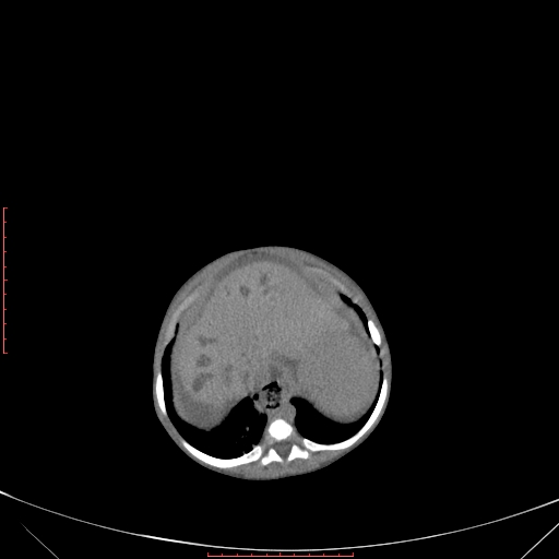 Autosomal recessive polycystic kidney disease associated with Caroli disease (Radiopaedia 61932-69984 Axial non-contrast 105).jpg