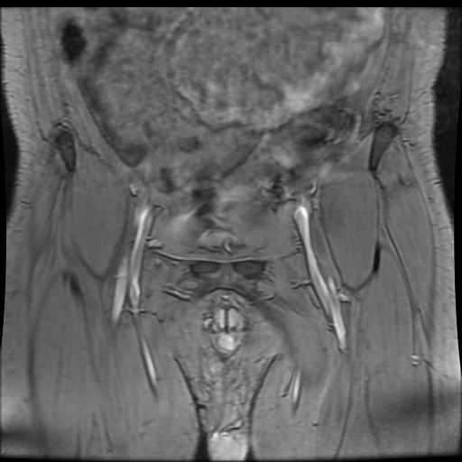Avascular necrosis of the hip (Radiopaedia 61503-69465 F 4).jpg