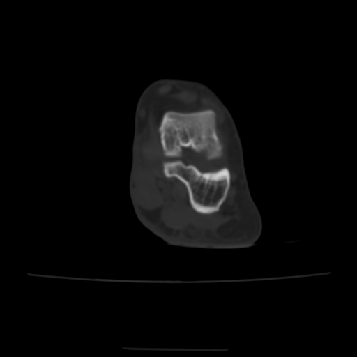 Avulsion fracture of the dorsal cuboid bone (Radiopaedia 51586-57377 Axial bone window 38).jpg