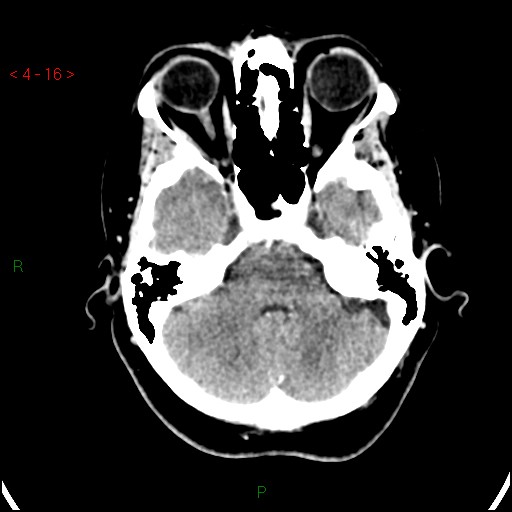 Azygos anterior cerebral artery (Radiopaedia 51987-57833 A 16).jpg