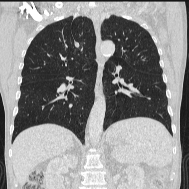 Azygos lobe (Radiopaedia 38259-40275 Coronal lung window 49).jpg