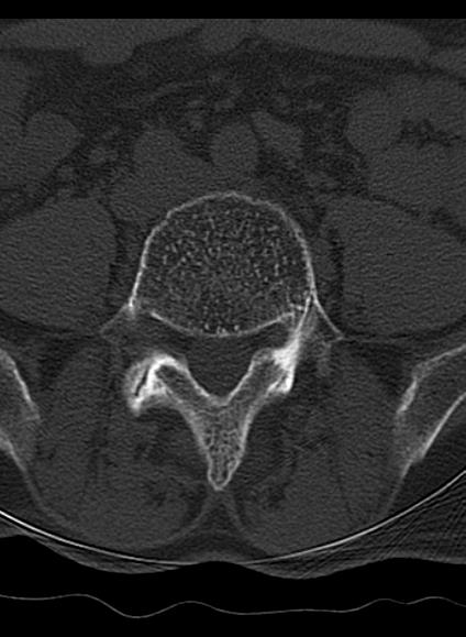 File:Baastrup syndrome (Radiopaedia 64891-73838 Axial bone window 9).jpg