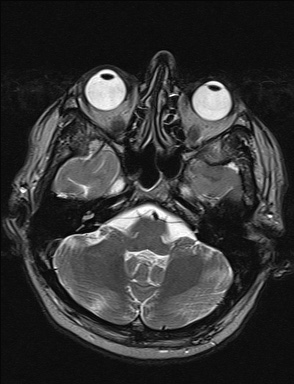 File:Balo concentric sclerosis (Radiopaedia 50458-55940 Axial T2 35).jpg