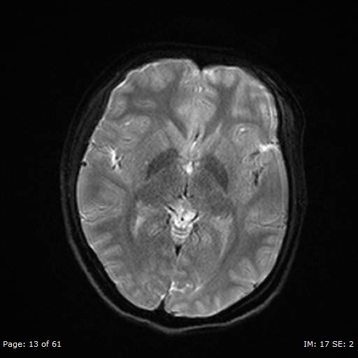 File:Balo concentric sclerosis (Radiopaedia 61637-69636 Axial DWI 13).jpg