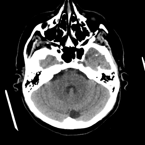 Basal ganglia metastasis (Radiopaedia 78928-91830 Axial non-contrast 20).png