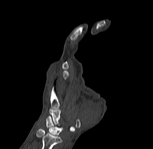 Base of 2nd metacarpal fracture (Radiopaedia 73741-84544 Coronal bone window 36).jpg