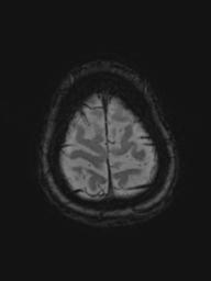 Base of skull chondrosarcoma (Radiopaedia 30410-31070 Axial SWI 52).jpg