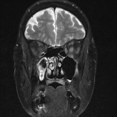 File:Base of skull chondrosarcoma (Radiopaedia 30410-31070 Coronal T2 fat sat 8).jpg
