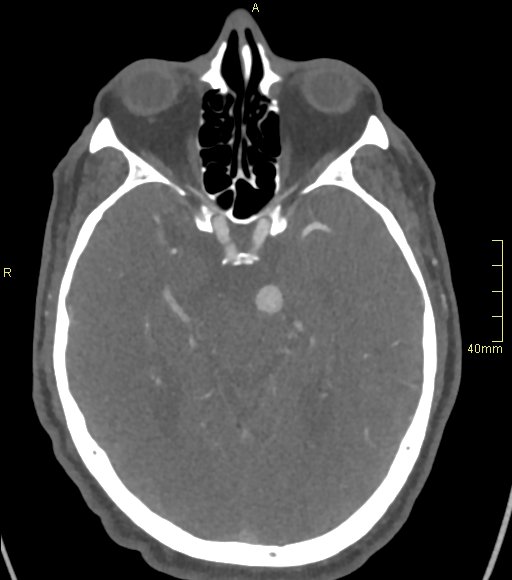 Basilar artery aneurysm (Radiopaedia 56261-62932 A 71).jpg