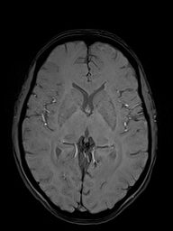 Basilar artery perforator aneurysm (Radiopaedia 82455-97733 Axial SWI 29).jpg