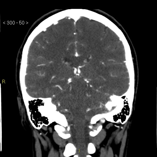 File:Basilar artery thrombosis (Radiopaedia 16260-15944 B 41).jpg