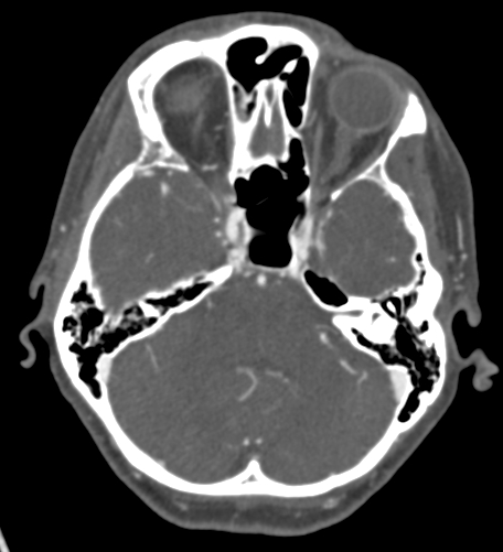 Basilar tip aneurysm with coiling (Radiopaedia 53912-60086 A 44).jpg