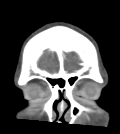 Basilar tip aneurysm with coiling (Radiopaedia 53912-60086 B 5).jpg