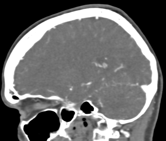 File:Basilar tip aneurysm with coiling (Radiopaedia 53912-60086 C 45).jpg