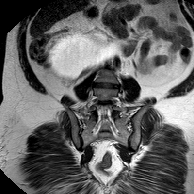 File:Benign seromucinous cystadenoma of the ovary (Radiopaedia 71065-81300 F 24).jpg