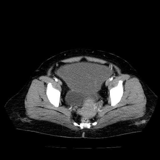 Benign spindle cell tumor - abdominopelvic (Radiopaedia 61300-69212 A 53).jpg