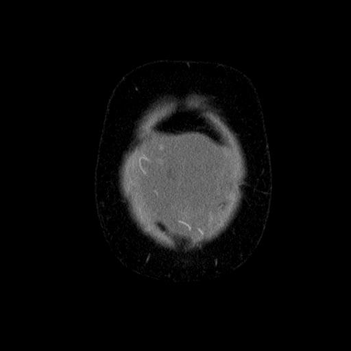 File:Benign spindle cell tumor - abdominopelvic (Radiopaedia 61300-69212 C 6).jpg