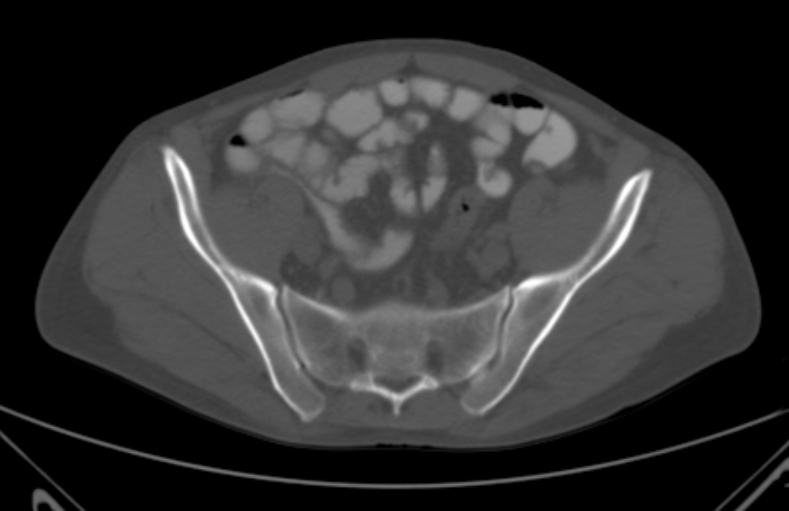 File:Bertolotti syndrome (Radiopaedia 58974-66235 Axial bone window 2).jpg