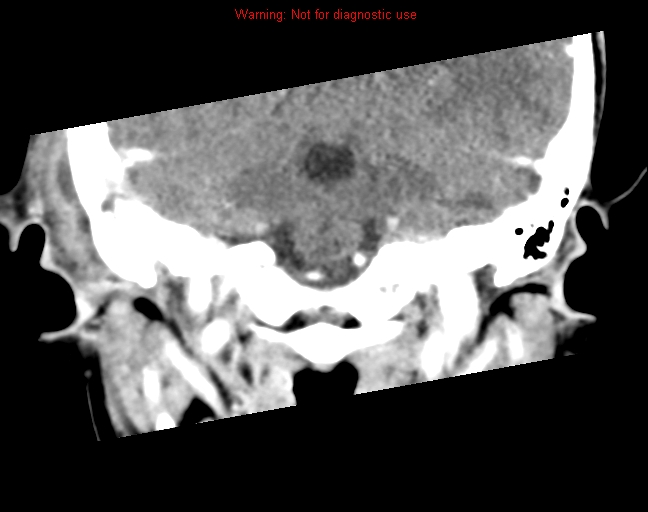 File:Bezold abscess (Radiopaedia 21645-21605 C+ arterial phase 14).jpg
