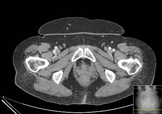 Bicameral celiacomesenteric aneurysm (Radiopaedia 55766-62327 A 75).jpg