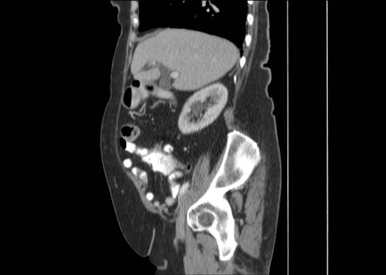 File:Bicameral celiacomesenteric aneurysm (Radiopaedia 55766-62327 B 20).jpg