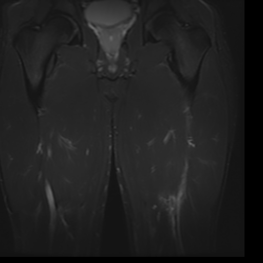 File:Biceps femoris strain injury (Radiopaedia 16800-16515 Coronal STIR 9).jpg