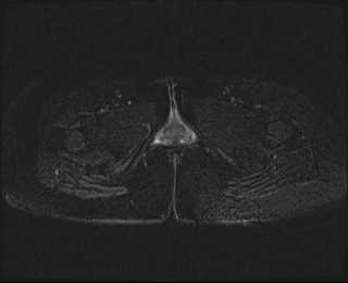 File:Bicornuate bicollis uterus (Radiopaedia 61626-69616 Axial PD fat sat 37).jpg