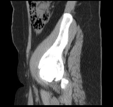 File:Bicornuate uterus (MRI) (Radiopaedia 49206-54296 Sagittal 20).png