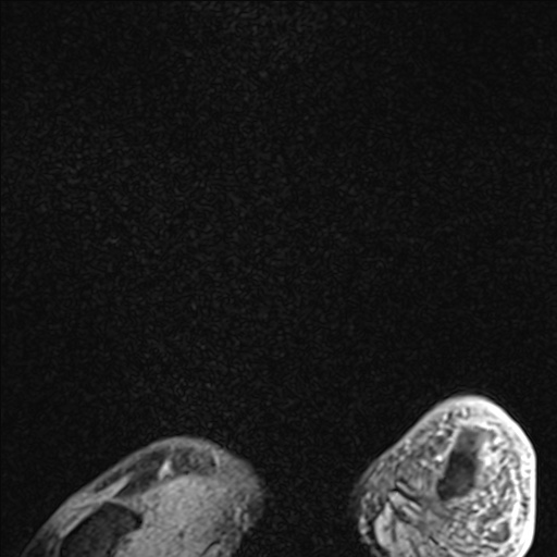 Bilateral Achilles tendon complete tear (Radiopaedia 81344-95051 Sagittal WE - Right 109).jpg