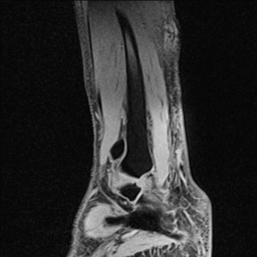 Bilateral Achilles tendon complete tear (Radiopaedia 81344-95051 Sagittal WE - Right 29).jpg