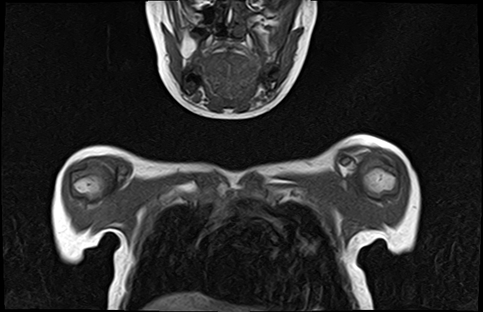 File:Bilateral Sprengel deformity with Klippel-Feil syndrome (Radiopaedia 66395-75650 Coronal T1 4).jpg