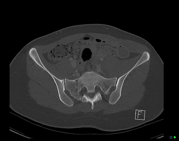 File:Bilateral acetabular fractures (Radiopaedia 79272-92308 Axial bone window 19).jpg