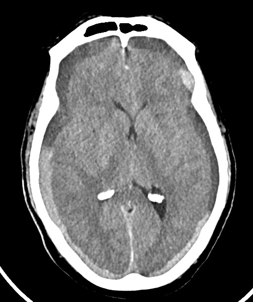 Bilateral acute on chronic subdural hematomas (Radiopaedia 78466-91146 Axial non-contrast 29).jpg