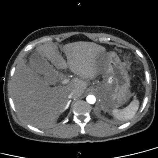 Bilateral adrenal gland hyperenhancement in pancreatitis (Radiopaedia 86642-102753 B 26).jpg