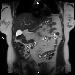 File:Bilateral adrenal myelolipoma (Radiopaedia 63058-71537 Coronal T2 24).jpg