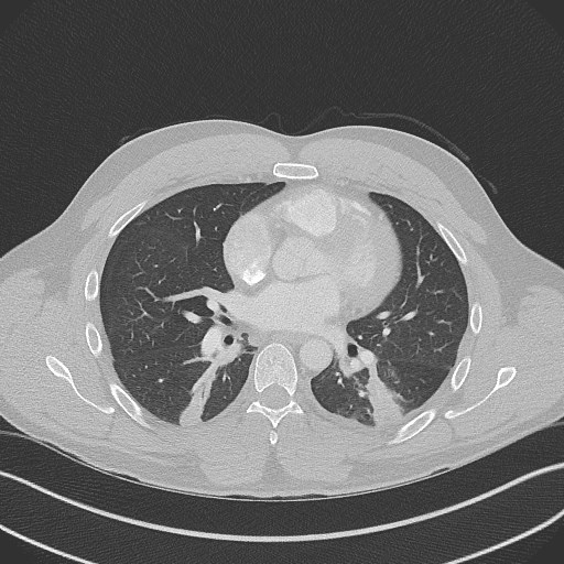 Bilateral atelectasis (Radiopaedia 48666-53675 Axial lung window 62).jpg
