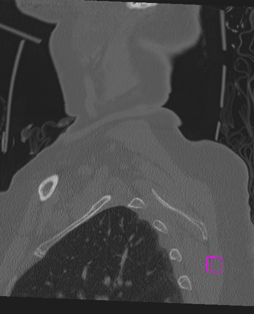 Bilateral atlanto-occipital assimilation (Radiopaedia 28350-28603 Sagittal bone window 77).jpg