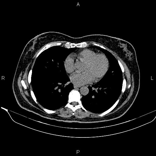 File:Bilateral benign adrenal adenomas (Radiopaedia 86912-103124 Axial non-contrast 6).jpg